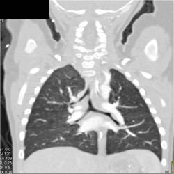 Tracheal Bronchus With Normal Arch - CTisus CT Scan