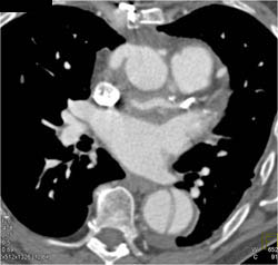 Cad With Dissection - CTisus CT Scan