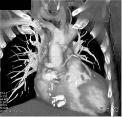 Bypass Graft Off Ascending Aorta With Unusual Positioning - CTisus CT Scan