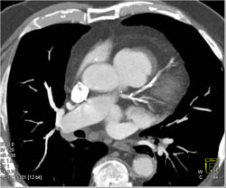 LAD and Circumflex Disease - CTisus CT Scan