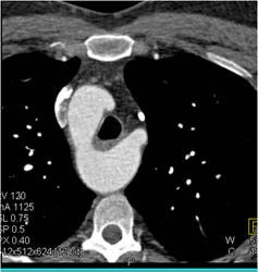 Right Sided Arch With Incomplete Ring - CTisus CT Scan