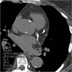 Agatston Score of Over 2000 - CTisus CT Scan