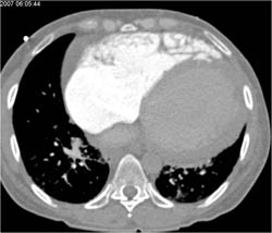 Poor Right Heart Function With Reflux Into the IVC - CTisus CT Scan