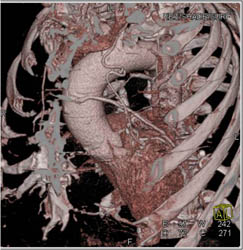 Left Internal Mammary Artery (LIMA) and Venous Bypass Grafts - CTisus CT Scan