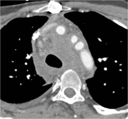 Lymphoma Infiltrates Mediastinum - CTisus CT Scan