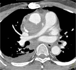 Ascending Aortic Repair and Reimplant of Right Subclavian Artery - CTisus CT Scan