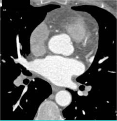 Normal RCA - CTisus CT Scan