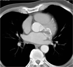 Old Infarct Near LAD - CTisus CT Scan