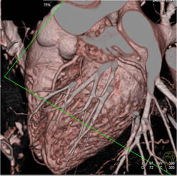 Normal LAD - CTisus CT Scan