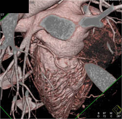 Normal LAD - CTisus CT Scan