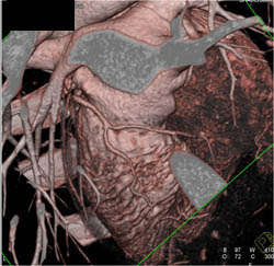 Normal LAD - CTisus CT Scan