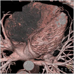 Normal RCA - CTisus CT Scan