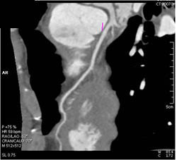 Normal LAD - CTisus CT Scan