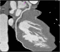 Normal LAD - CTisus CT Scan