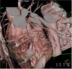 Normal LAD - CTisus CT Scan