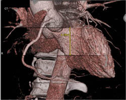 Artifact of Rotation - CTisus CT Scan