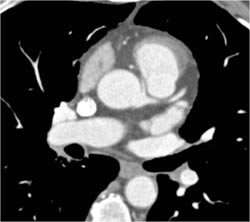 RCA Arises Off Left Cusp- Malignant Type - CTisus CT Scan