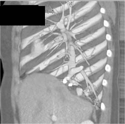 Partial Anomalous Pulmonary Venous Return (PAPVR) S/P Embolization - CTisus CT Scan