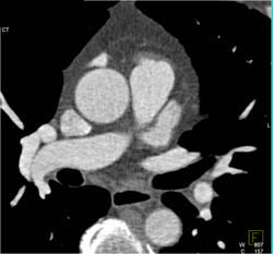 Diseased LAD - CTisus CT Scan