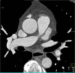 Diseased LAD - CTisus CT Scan