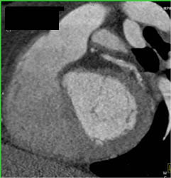 Diseased LAD - CTisus CT Scan