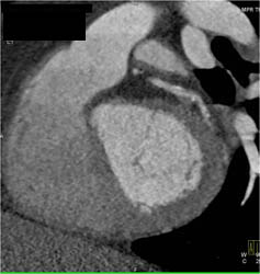 Diseased LAD - CTisus CT Scan