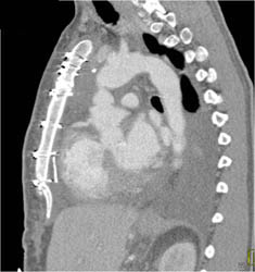 Foreign Body Behind Sternum on Sagittal View - CTisus CT Scan