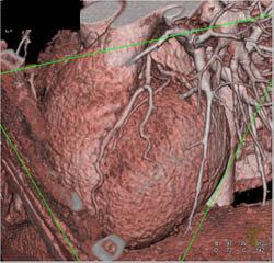 Normal LAD - CTisus CT Scan