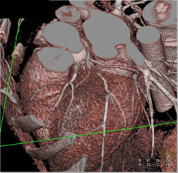 Normal LAD - CTisus CT Scan