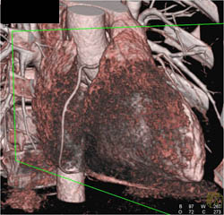 Normal RCA - CTisus CT Scan