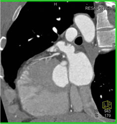 Plaque in LAD - CTisus CT Scan