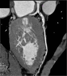 Plaque in LAD - CTisus CT Scan