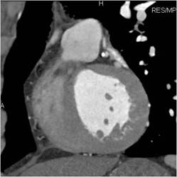 Plaque in LAD - CTisus CT Scan