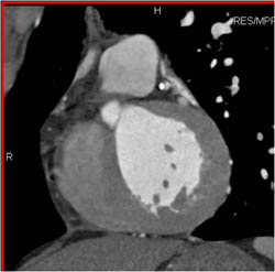 Plaque in LAD - CTisus CT Scan