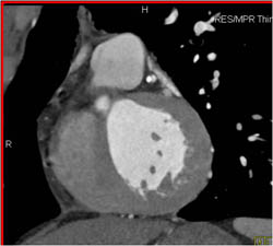 Plaque in LAD - CTisus CT Scan