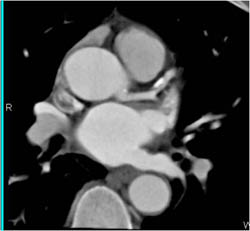 Plaque in LAD - CTisus CT Scan