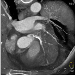 Greater Than 50% LAD Disease - CTisus CT Scan