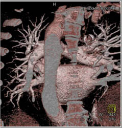 View From the Spine Forward - Nice Pulmonary Veins - CTisus CT Scan