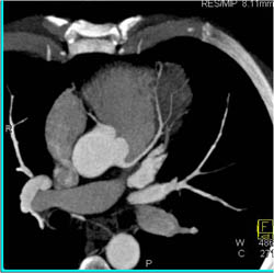 Sliding MIP of Normal LAD - CTisus CT Scan