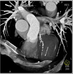 Diseased LAD - CTisus CT Scan