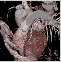 Diseased LAD - CTisus CT Scan