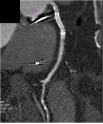 Diseased RCA With Patent Stent - CTisus CT Scan