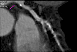 Diseased LAD - CTisus CT Scan