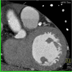 Diseased LAD - CTisus CT Scan