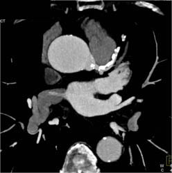 Extensive Calcified Plaque LAD - CTisus CT Scan