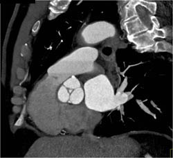 Normal Aortic Valve - CTisus CT Scan