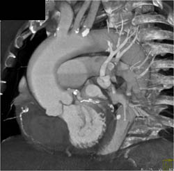 Dilated Ascending Aorta - CTisus CT Scan