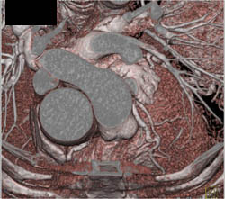 Dilated Ascending Aorta - CTisus CT Scan