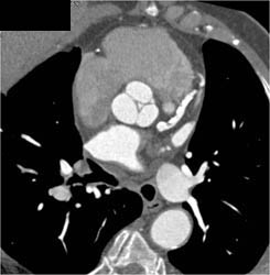 Normal Av But Diseased LAD - CTisus CT Scan