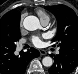 Diseased LAD - CTisus CT Scan